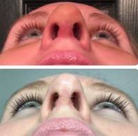 Bump inside nose after rhinoplasty surgery