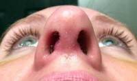 Cartilage bump after rhinoplasty