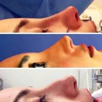 Closed rhinoplasty before after photos of surgery