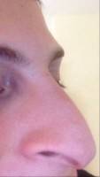 Reason for rhinoplasty