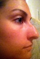 Reasons for rhinoplasty surgery(nose job)