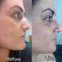 Rhinoplasty bump removal before and after image
