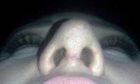 Rhinoplasty scar tissue formation