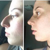 Septoplasty deviated septum before and after