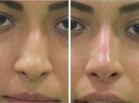 non surgical nose job with fillers