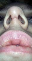 rhinoplasty scar after surgery